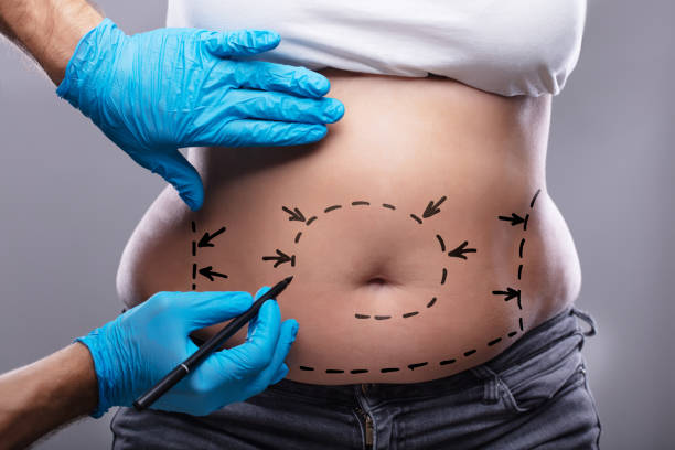 Body Contouring & Liposuction