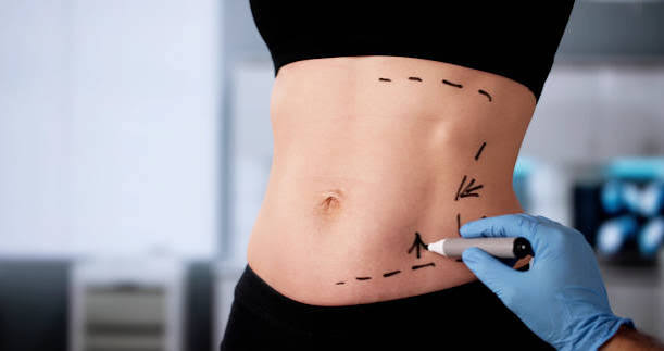 Best Doctor for Tummy Tuck in South Mumbai