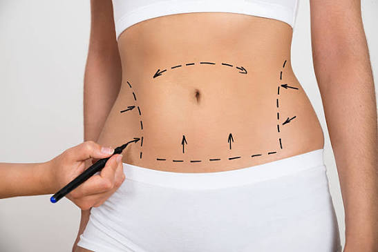 Best Liposuction Treatment in South Mumbai
